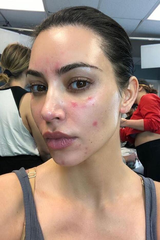 Psoriasis: la enfermedad del estrés y la ansiedad que padece Kim Kardashian