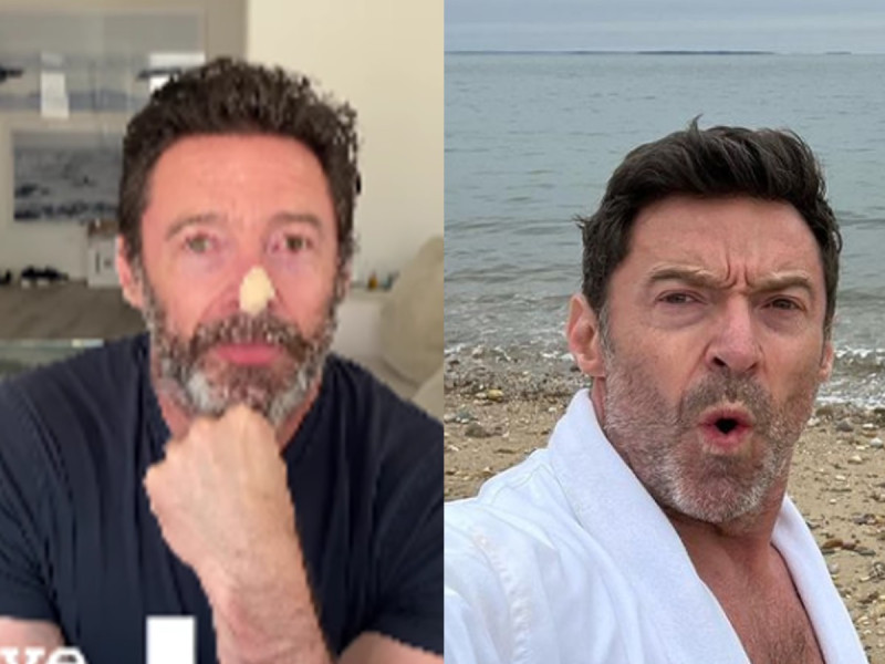 Cáncer de piel acecha a Hugh Jackman