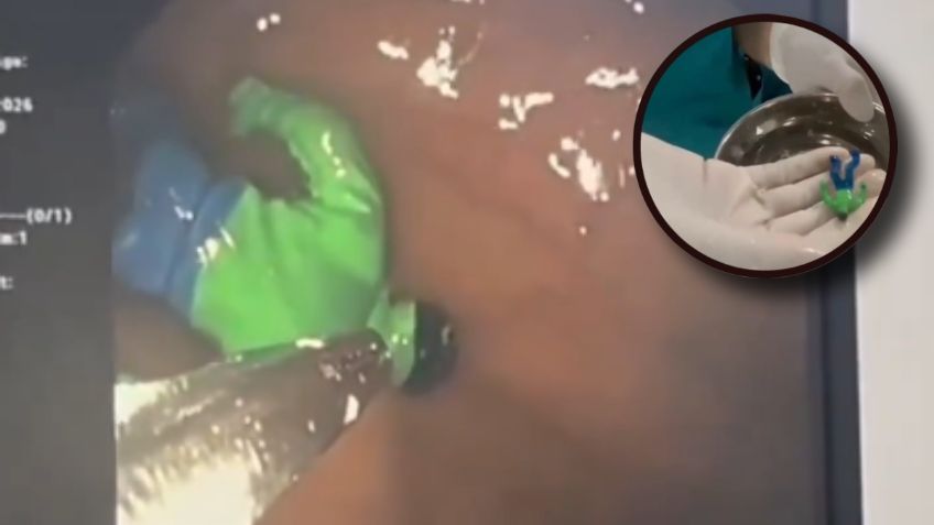 Niño tenía un fuerte dolor y médicos descubren un “Hulk” en el estómago