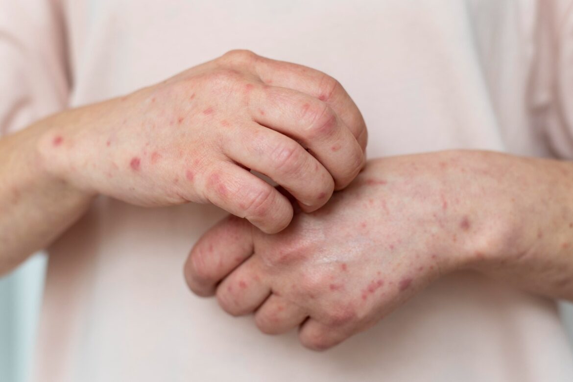 Casos de sarampión en México durante 2026 ya superan el total del año pasado